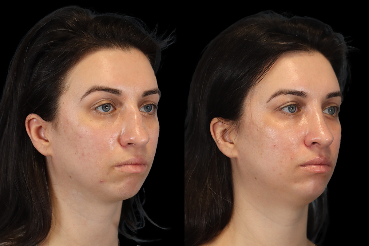 Rhinoplasty Before and After | Leong Facial Plastic Surgery