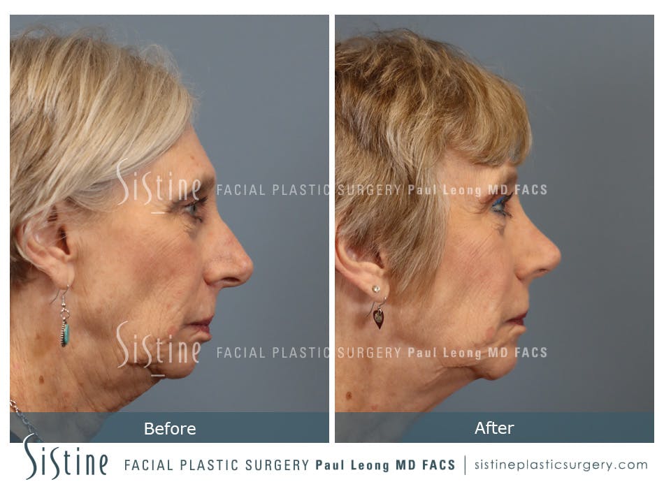Rhinoplasty Before and After | Leong Facial Plastic Surgery