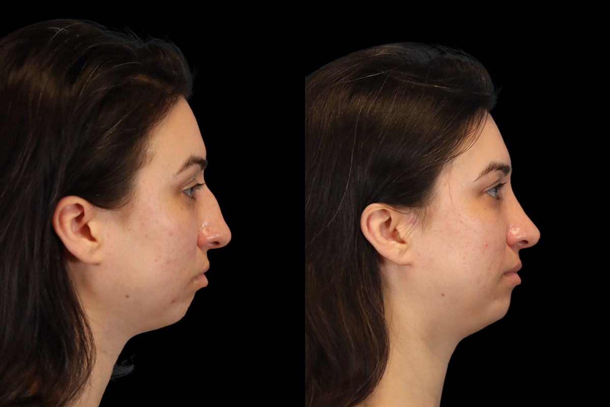 Rhinoplasty Before and After | Leong Facial Plastic Surgery