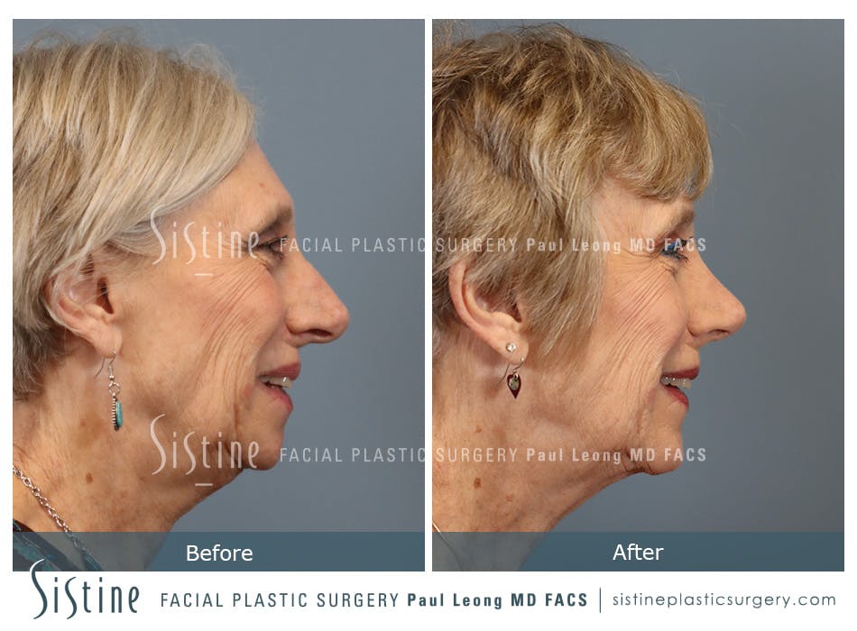 Rhinoplasty Before and After | Leong Facial Plastic Surgery