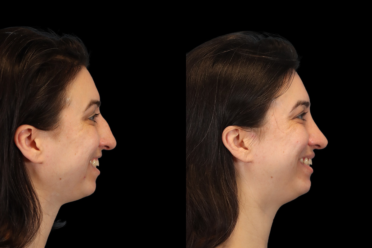 Rhinoplasty Before and After | Leong Facial Plastic Surgery