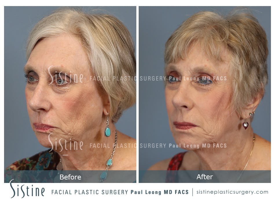 Rhinoplasty Before and After | Leong Facial Plastic Surgery