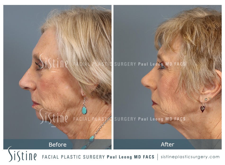 Rhinoplasty Before and After | Leong Facial Plastic Surgery