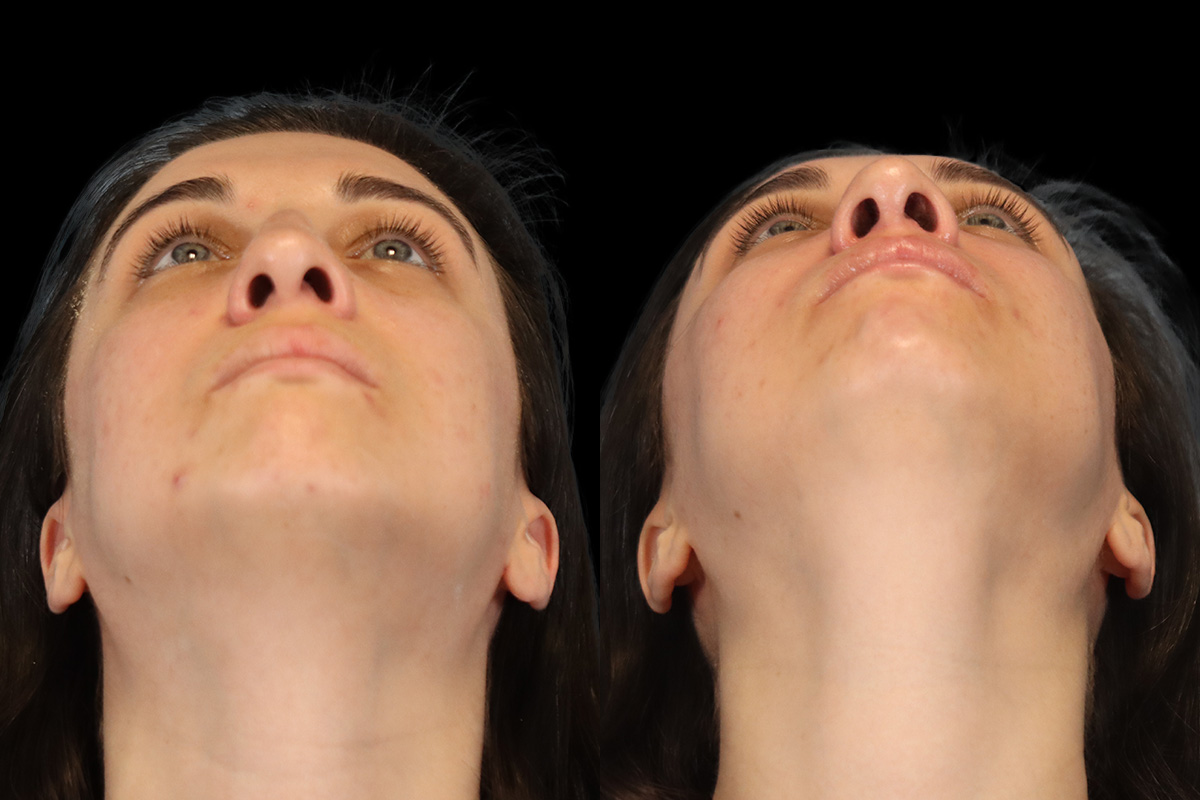 Rhinoplasty Before and After | Leong Facial Plastic Surgery