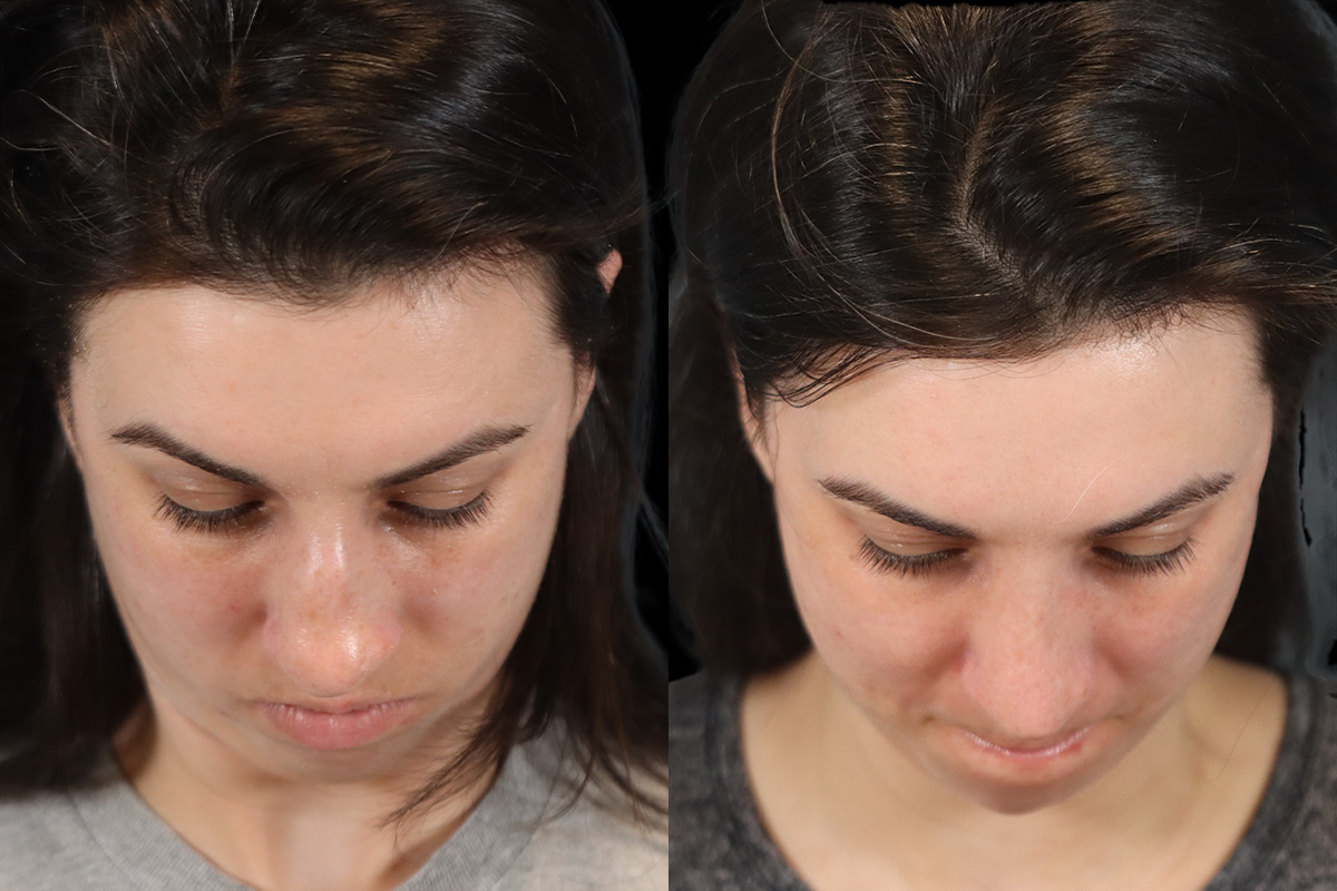 Rhinoplasty Before and After | Leong Facial Plastic Surgery