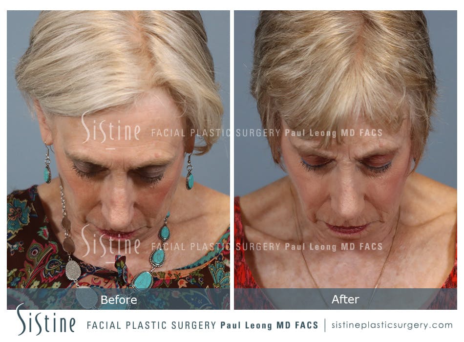 Rhinoplasty Before and After | Leong Facial Plastic Surgery
