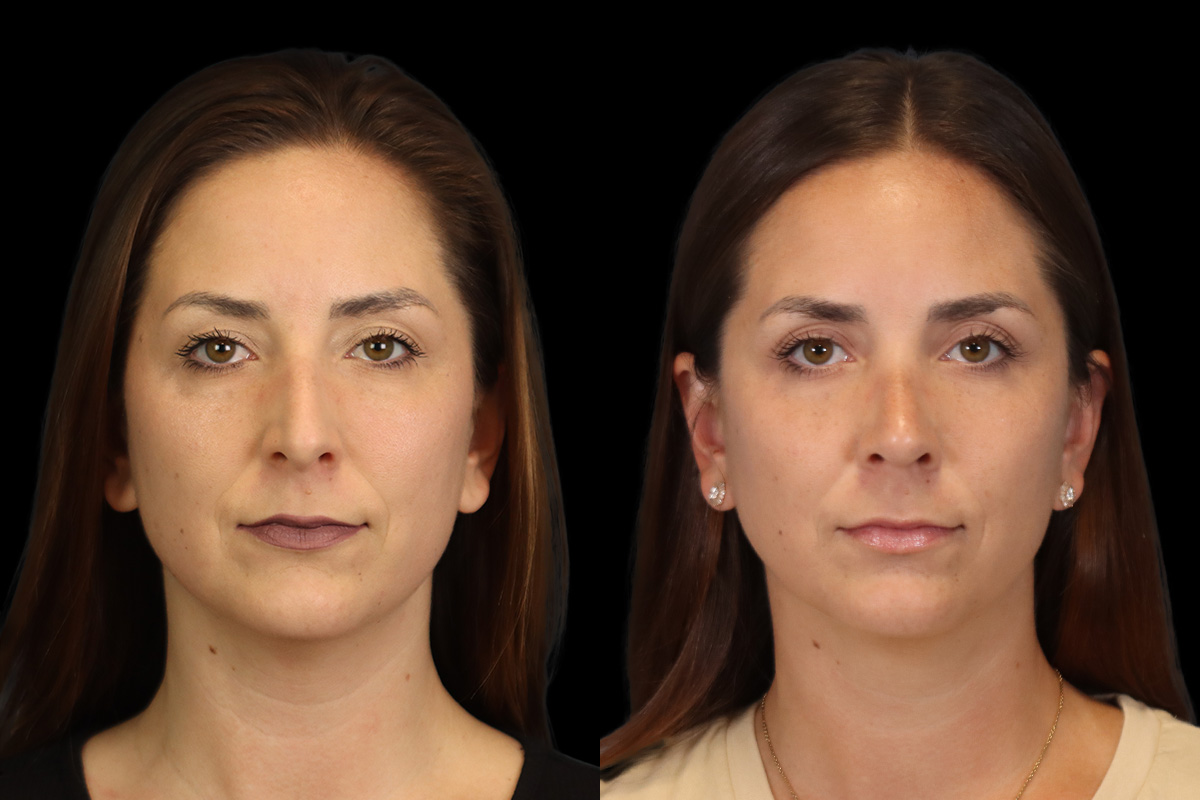 Rhinoplasty Before and After | Leong Facial Plastic Surgery