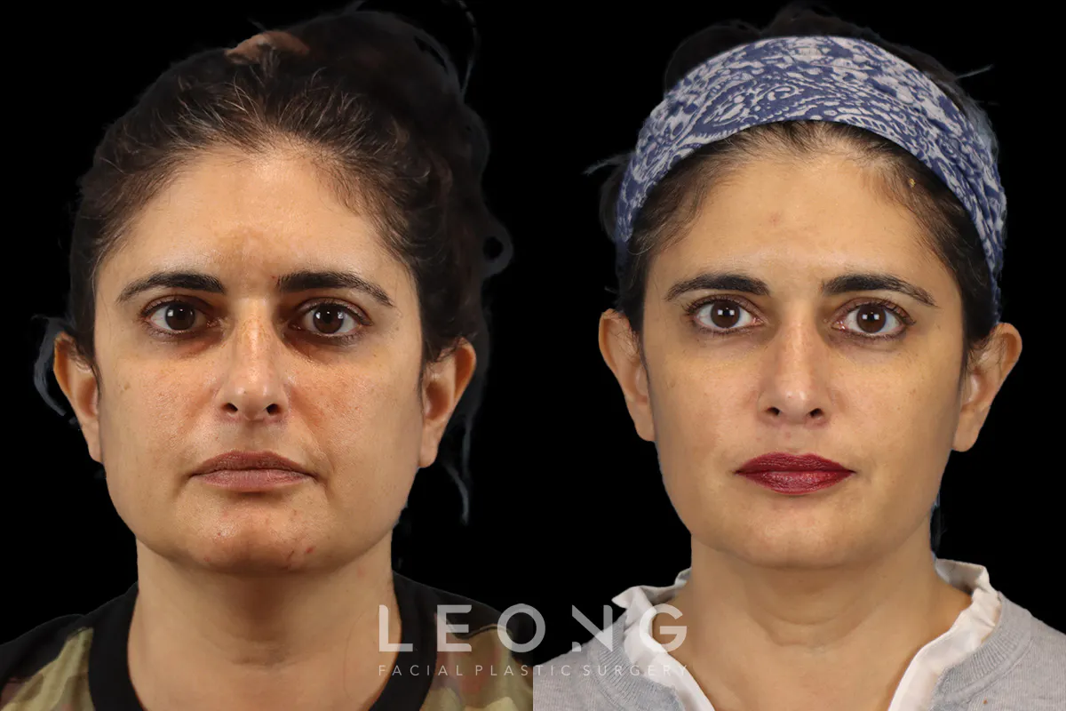 Rhinoplasty Before and After | Leong Facial Plastic Surgery