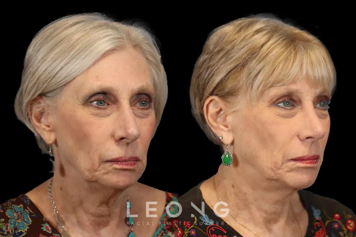 Rhinoplasty Before and After | Leong Facial Plastic Surgery