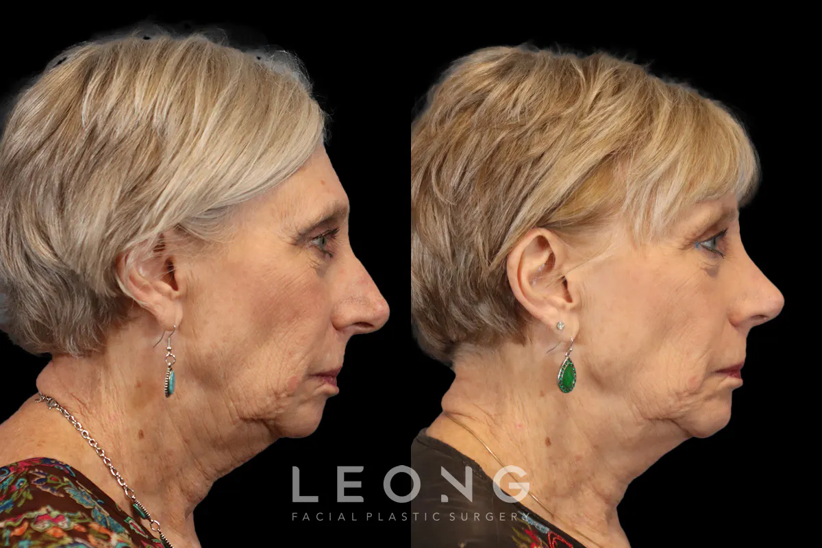 Rhinoplasty Before and After | Leong Facial Plastic Surgery