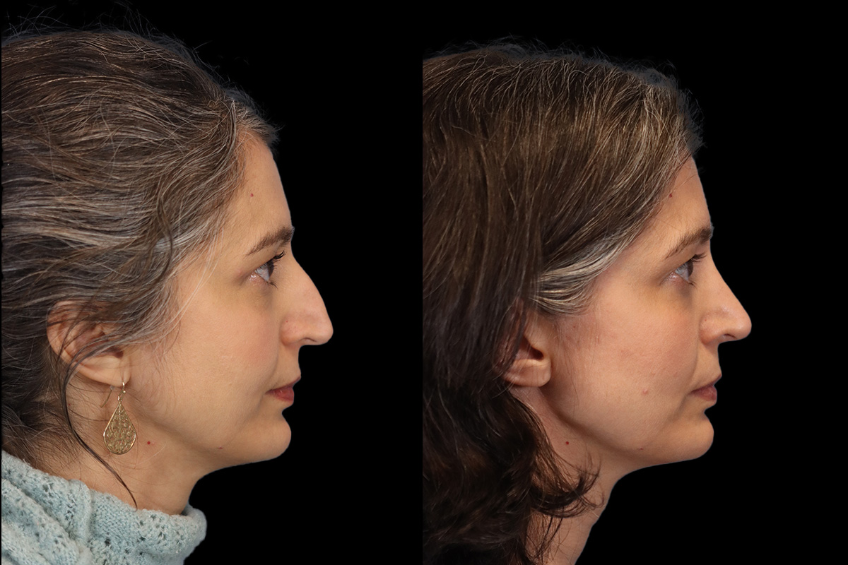 Rhinoplasty Before and After | Leong Facial Plastic Surgery