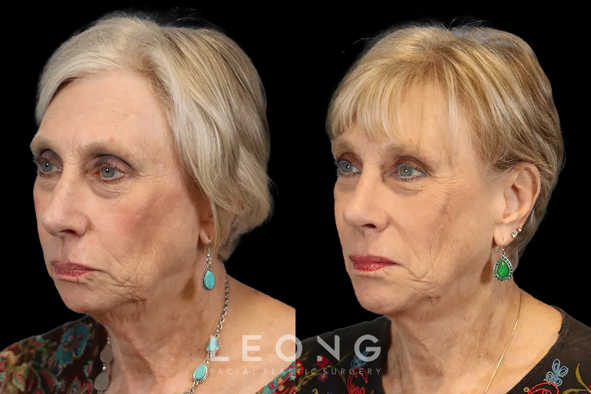 Rhinoplasty Before and After | Leong Facial Plastic Surgery