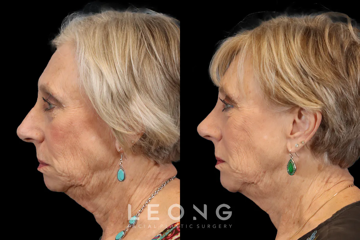 Rhinoplasty Before and After | Leong Facial Plastic Surgery