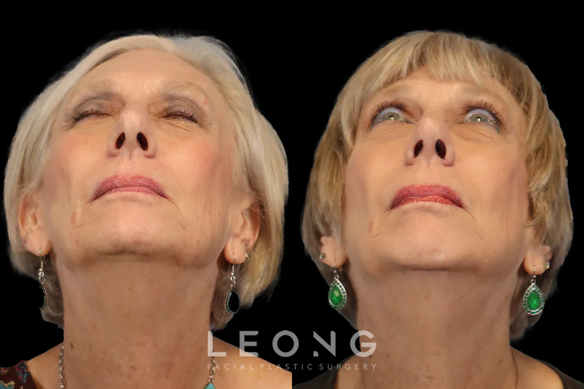 Rhinoplasty Before and After | Leong Facial Plastic Surgery