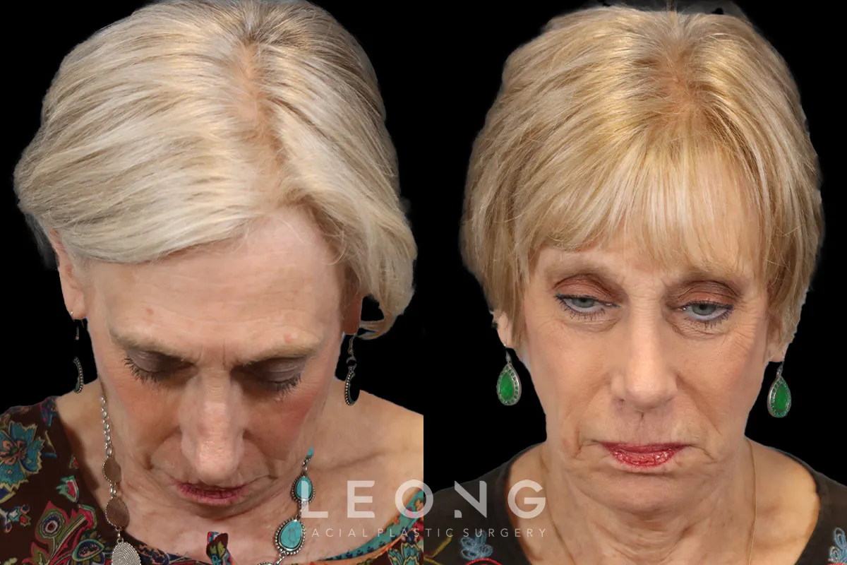 Rhinoplasty Before and After | Leong Facial Plastic Surgery