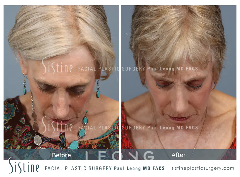 Rhinoplasty Before and After | Leong Facial Plastic Surgery