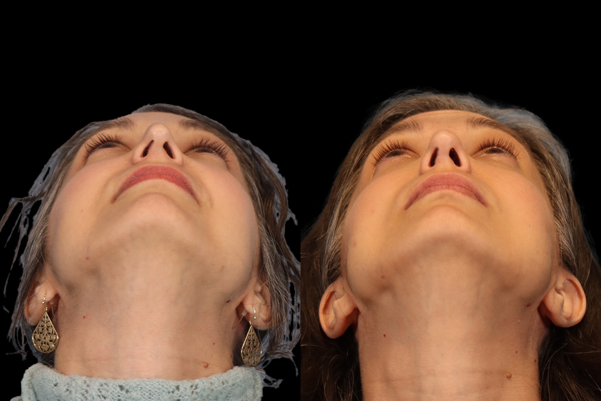 Rhinoplasty Before and After | Leong Facial Plastic Surgery