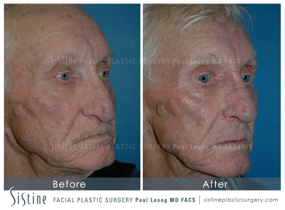 Rhinoplasty Before and After | Leong Facial Plastic Surgery