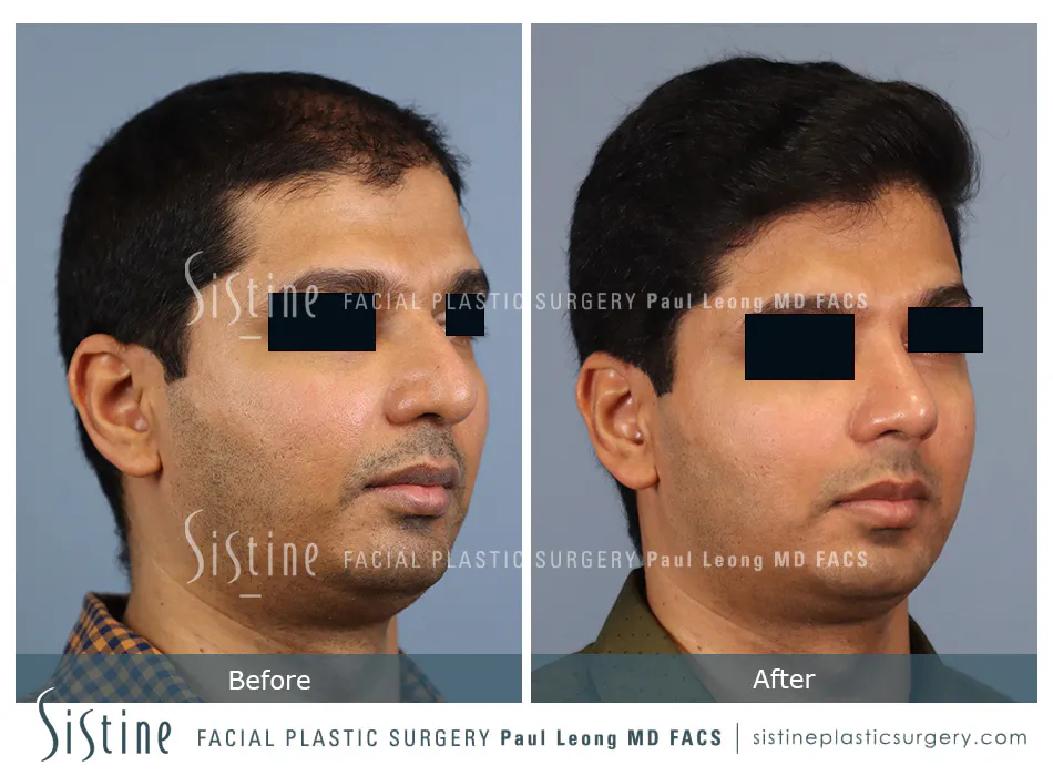Rhinoplasty Before and After | Leong Facial Plastic Surgery