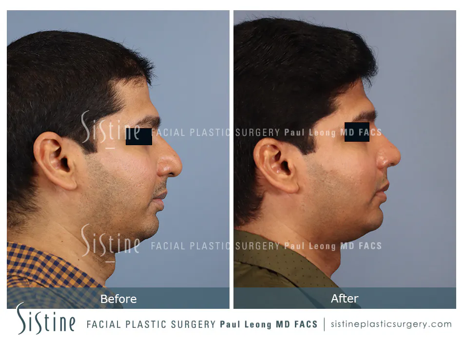 Rhinoplasty Before and After | Leong Facial Plastic Surgery