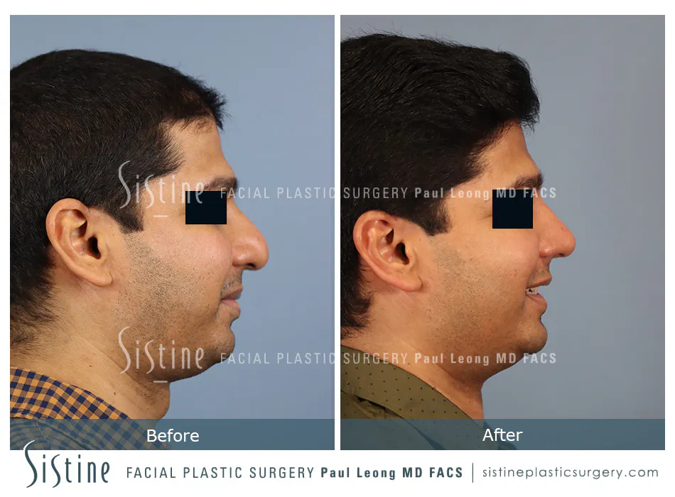Rhinoplasty Before and After | Leong Facial Plastic Surgery