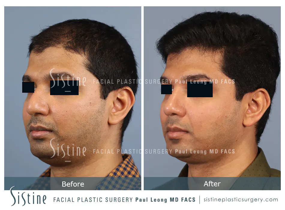 Rhinoplasty Before and After | Leong Facial Plastic Surgery
