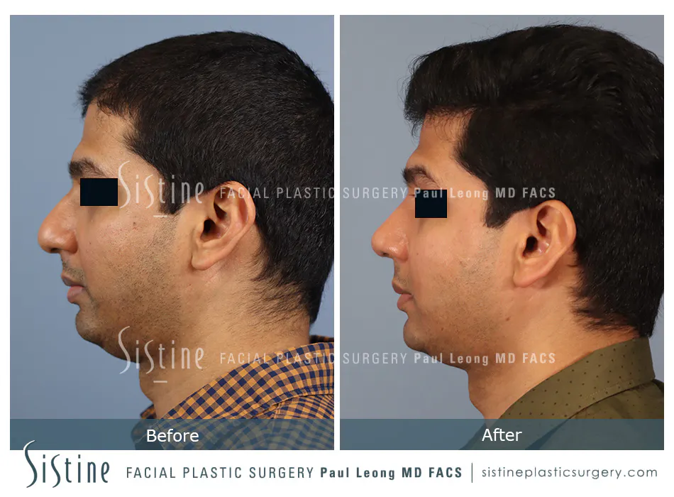 Rhinoplasty Before and After | Leong Facial Plastic Surgery