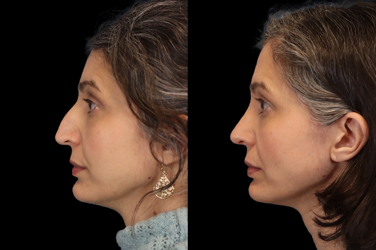 Rhinoplasty Before and After | Leong Facial Plastic Surgery