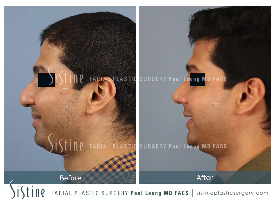 Rhinoplasty Before and After | Leong Facial Plastic Surgery