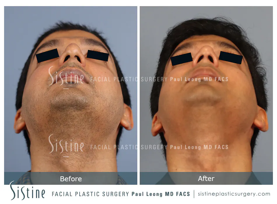 Rhinoplasty Before and After | Leong Facial Plastic Surgery