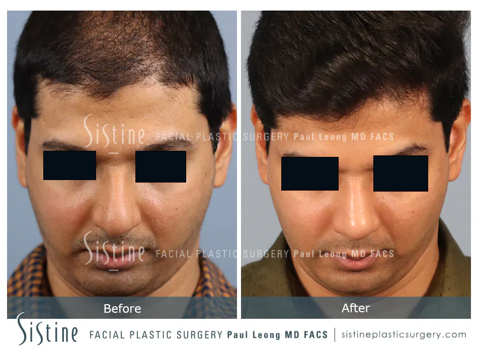 Rhinoplasty Before and After | Leong Facial Plastic Surgery