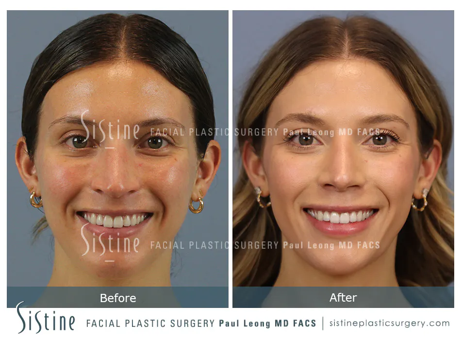 Rhinoplasty Before and After | Leong Facial Plastic Surgery
