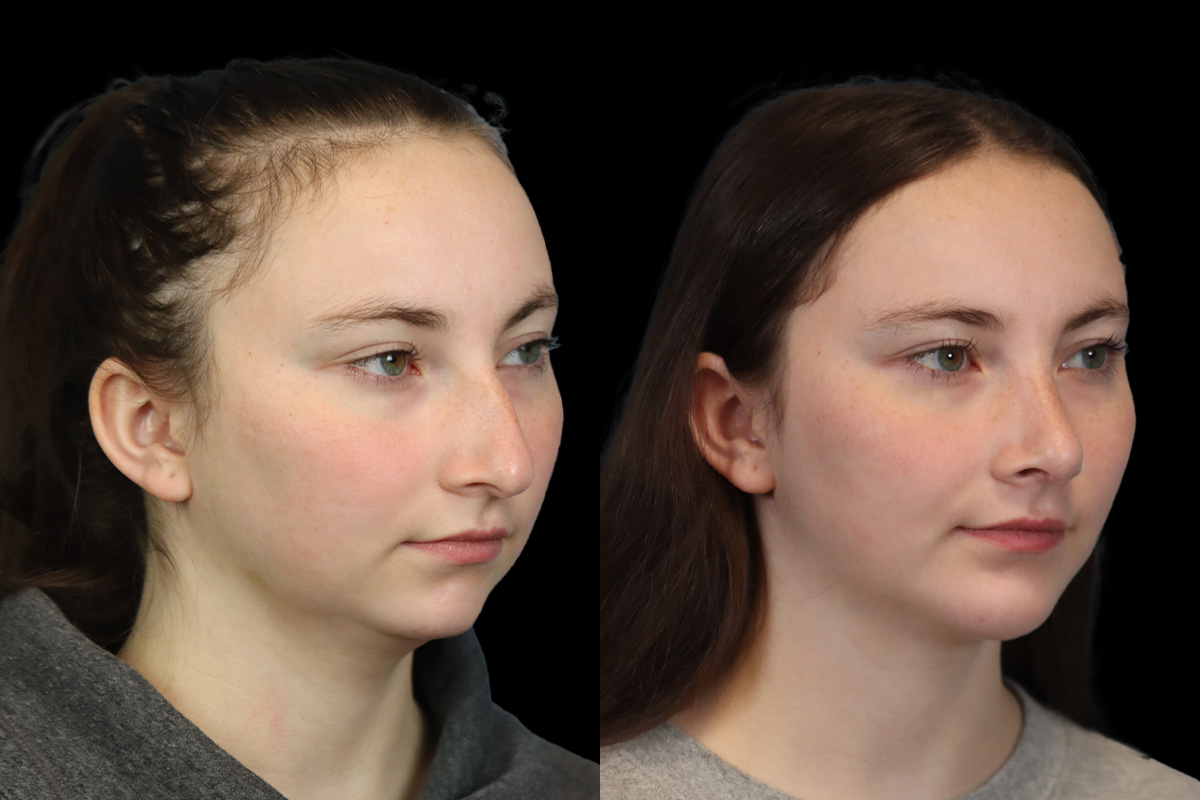 Rhinoplasty Before and After | Leong Facial Plastic Surgery