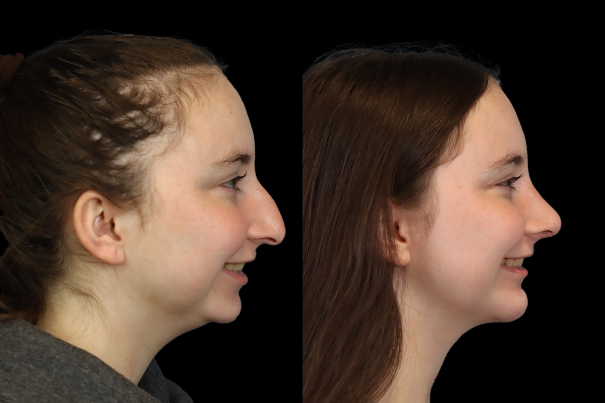 Rhinoplasty Before and After | Leong Facial Plastic Surgery