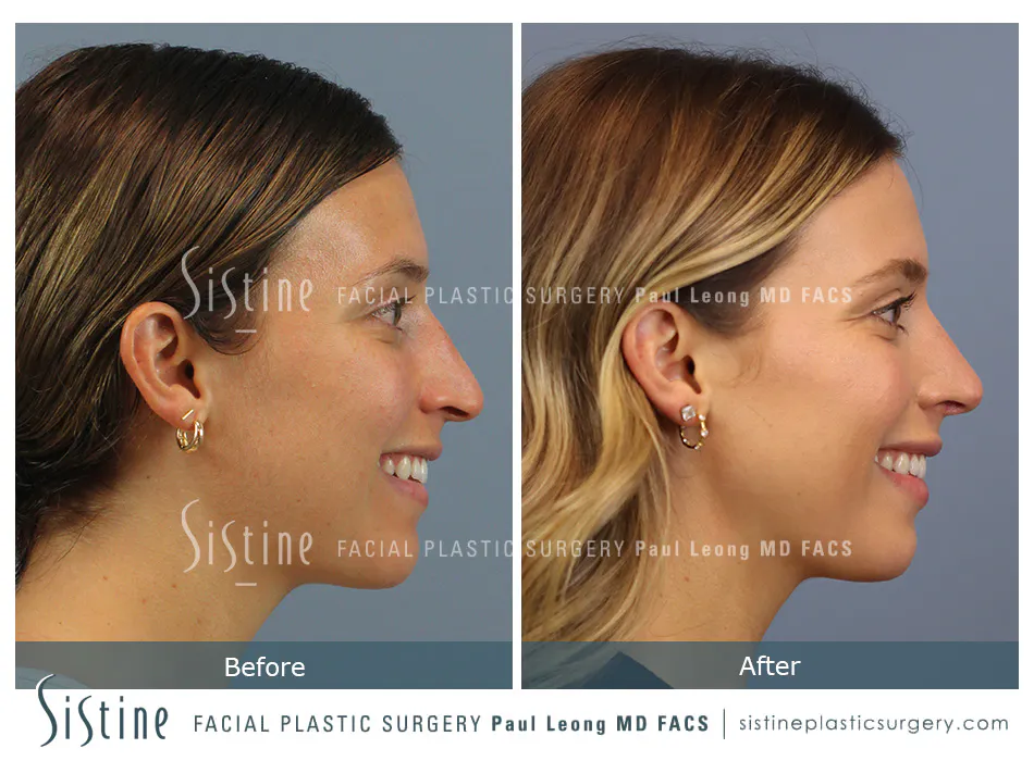 Rhinoplasty Before and After | Leong Facial Plastic Surgery