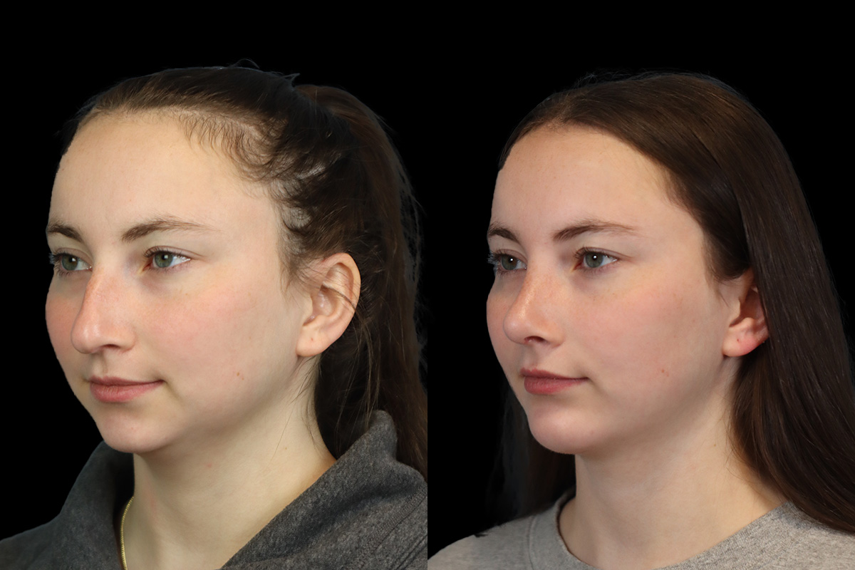 Rhinoplasty Before and After | Leong Facial Plastic Surgery