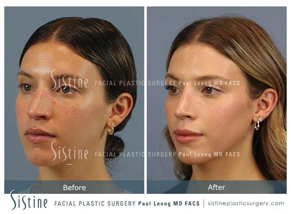 Rhinoplasty Before and After | Leong Facial Plastic Surgery