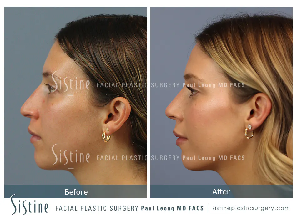 Rhinoplasty Before and After | Leong Facial Plastic Surgery