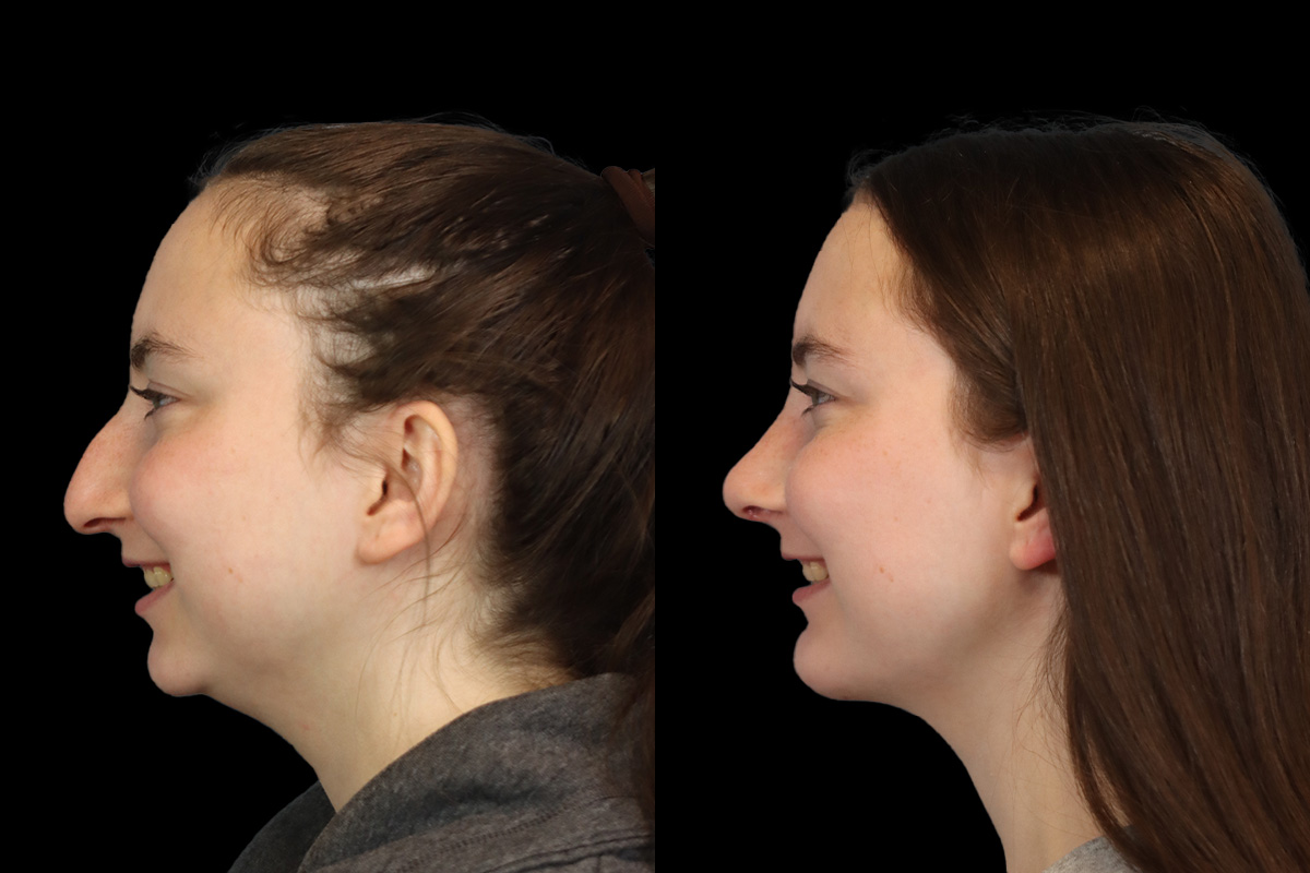 Rhinoplasty Before and After | Leong Facial Plastic Surgery