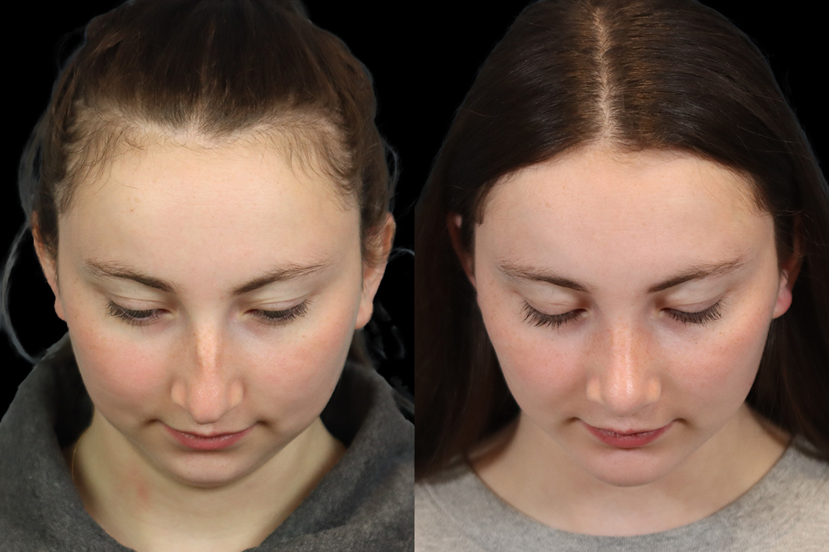Rhinoplasty Before and After | Leong Facial Plastic Surgery