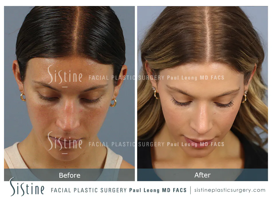 Rhinoplasty Before and After | Leong Facial Plastic Surgery