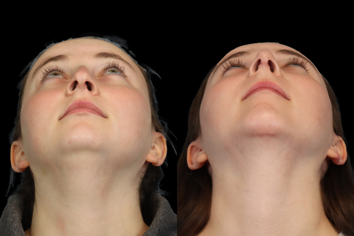 Rhinoplasty Before and After | Leong Facial Plastic Surgery