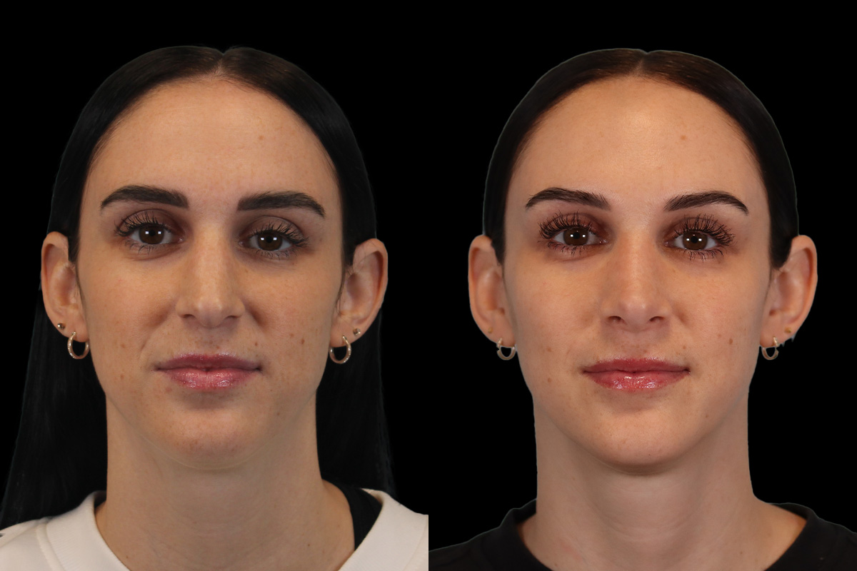 Rhinoplasty Before and After | Leong Facial Plastic Surgery