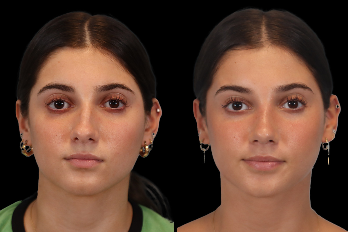 Rhinoplasty Before and After | Leong Facial Plastic Surgery