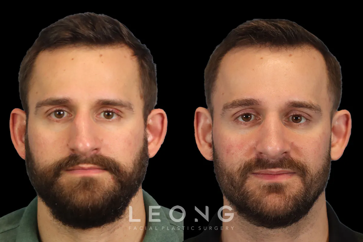 Rhinoplasty Before and After | Leong Facial Plastic Surgery