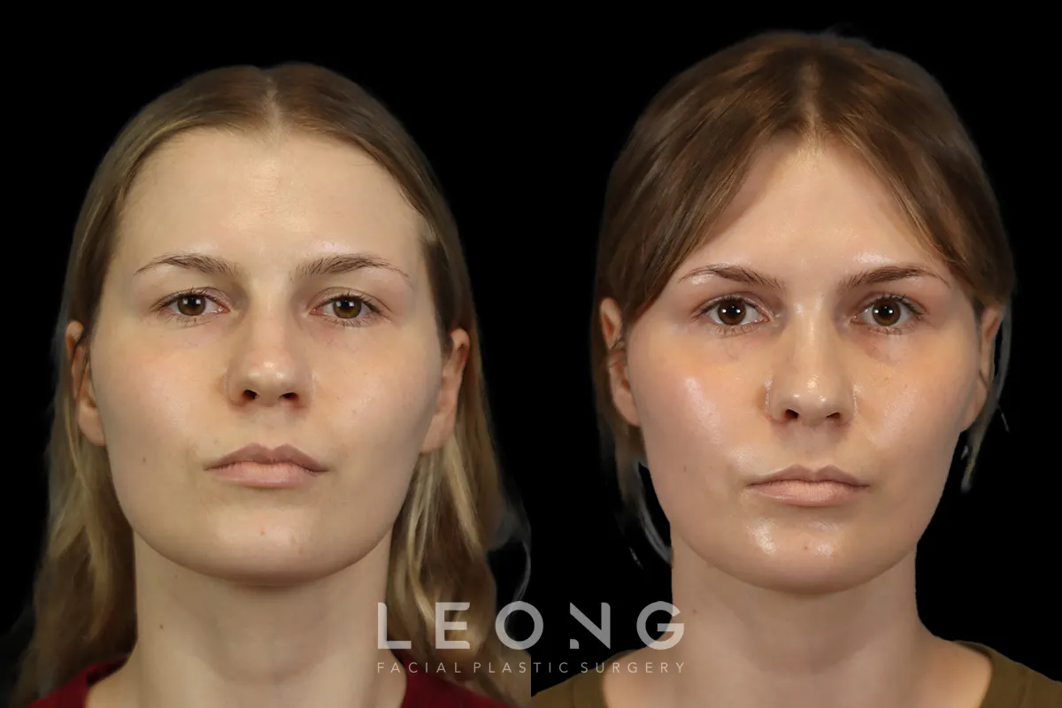 Rhinoplasty Before and After | Leong Facial Plastic Surgery