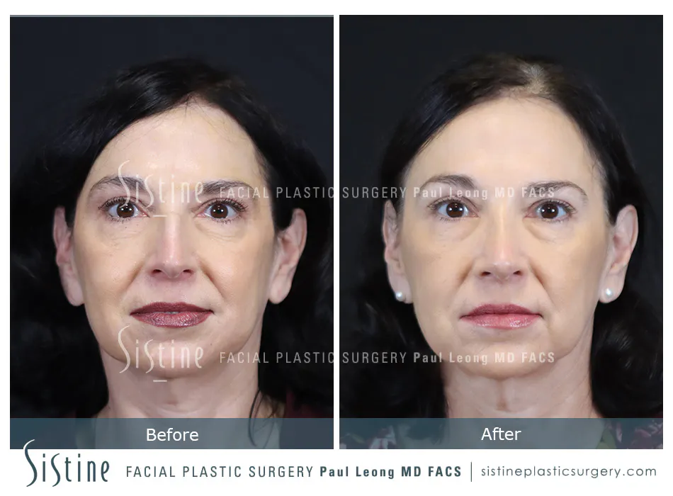 Rhinoplasty Before and After | Leong Facial Plastic Surgery