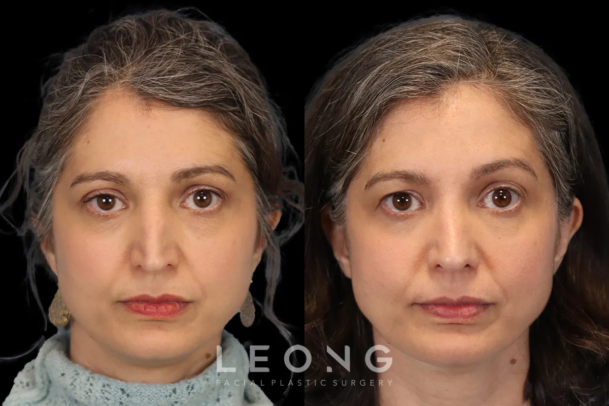 Rhinoplasty Before and After | Leong Facial Plastic Surgery