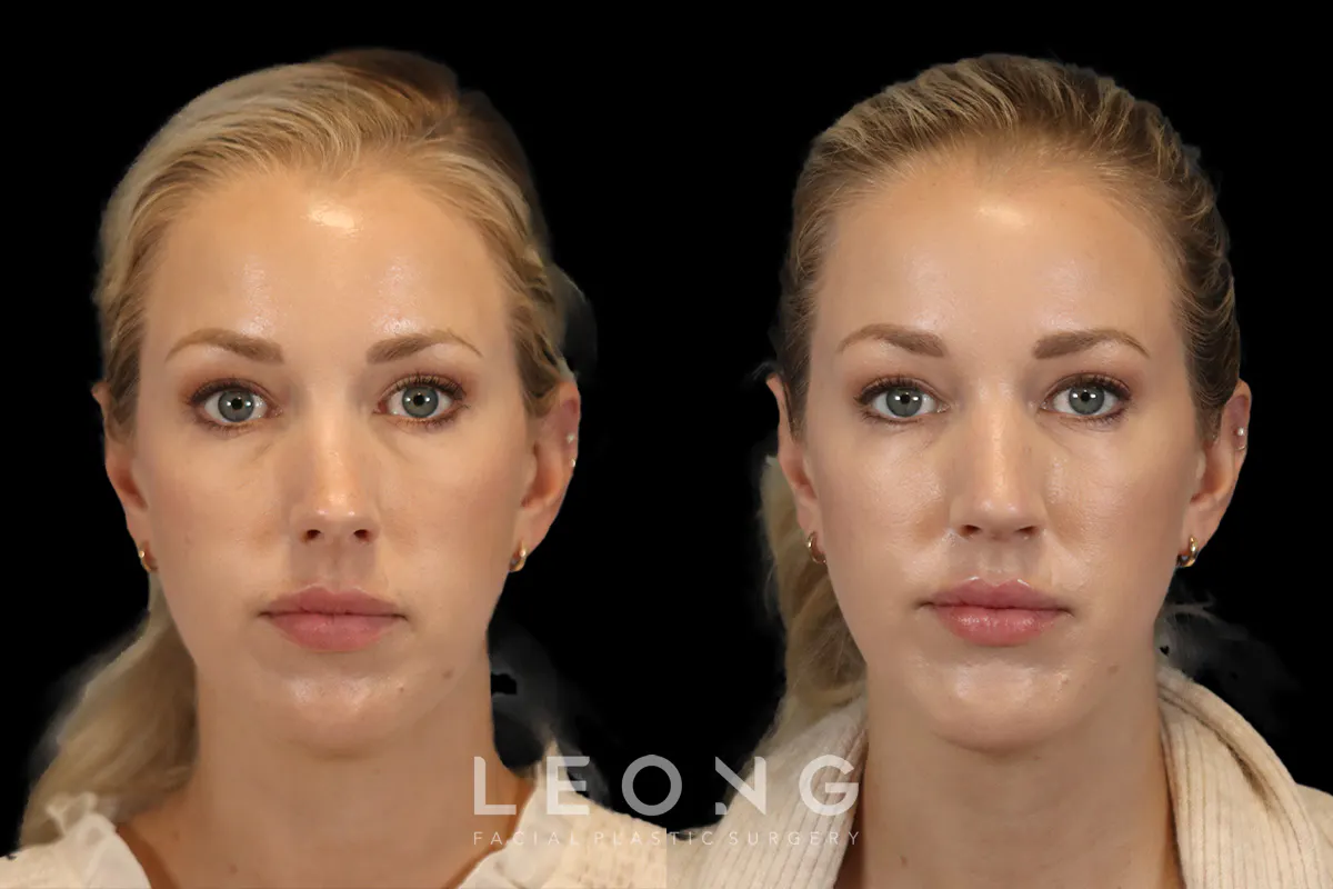 Rhinoplasty Before and After | Leong Facial Plastic Surgery