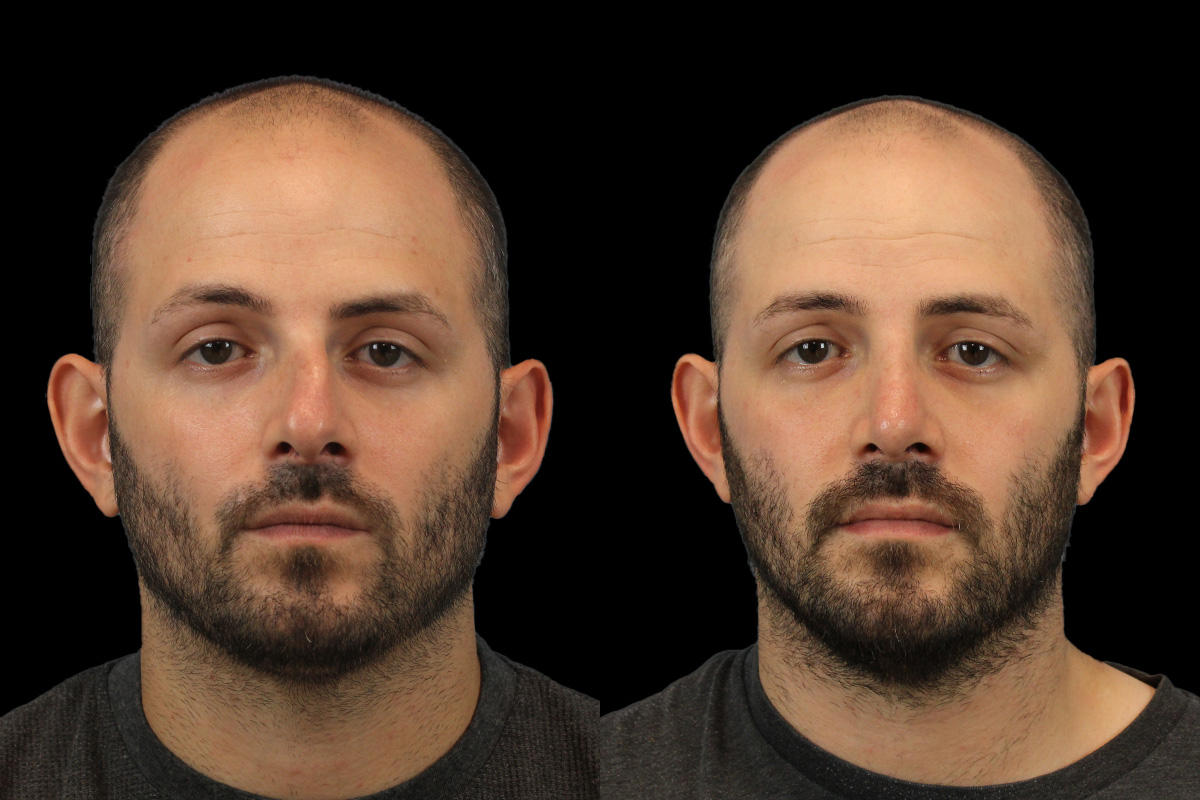 Rhinoplasty Before and After | Leong Facial Plastic Surgery